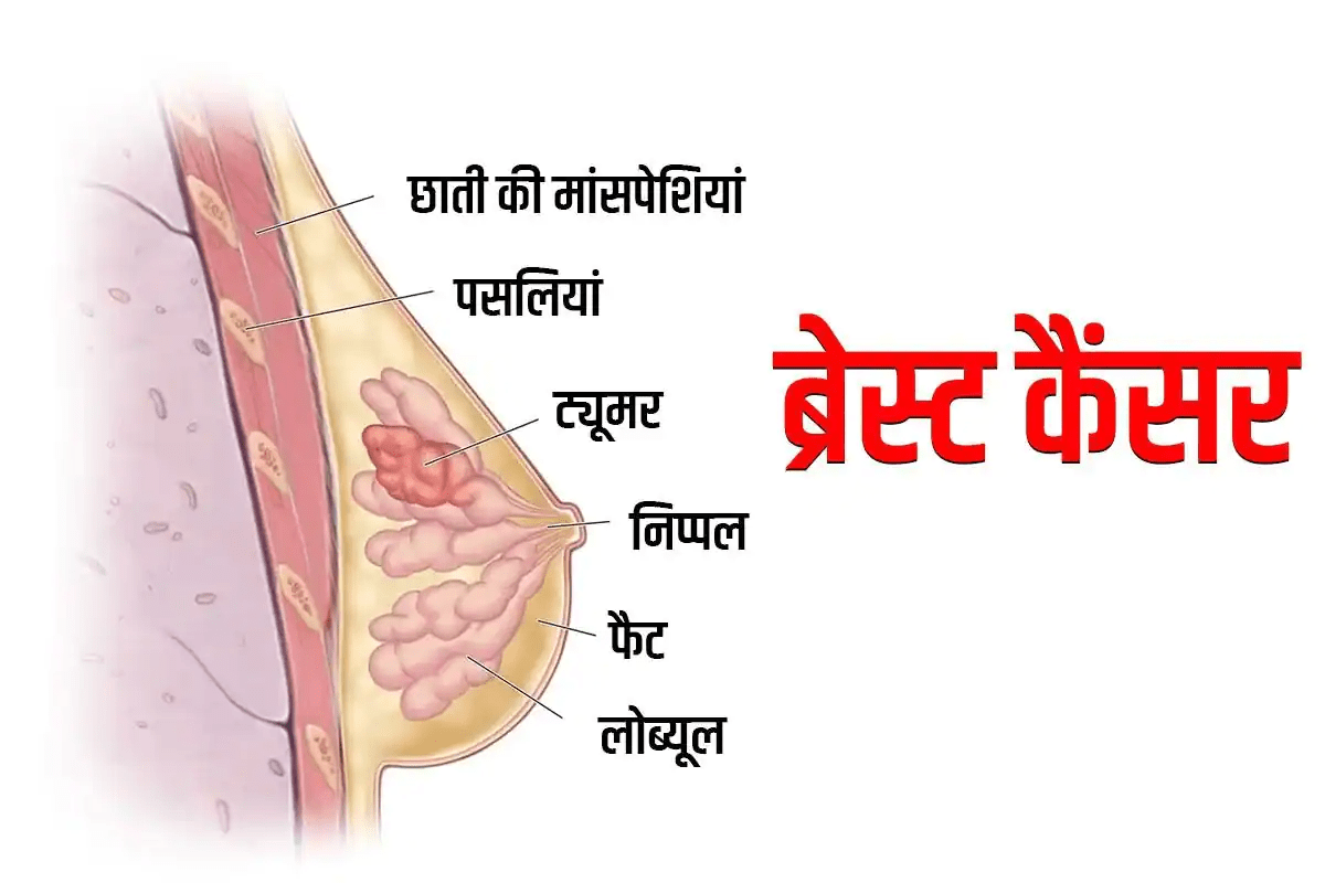 स्तन कैंसर नहीं है जानलेवा